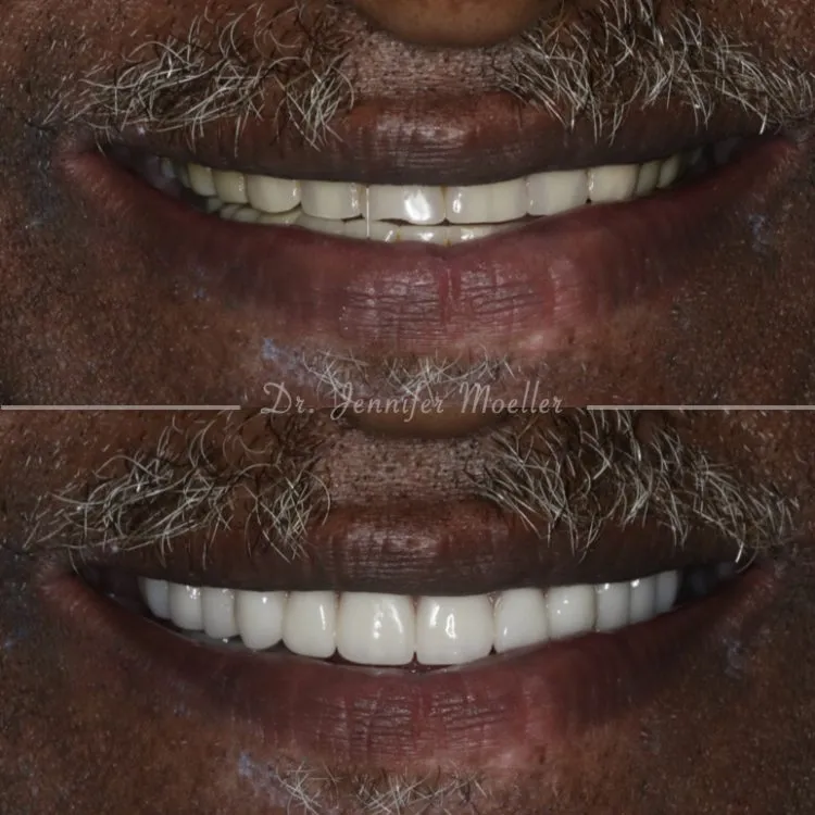 Dentadura completa antes y después