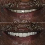 Complete denture before & after