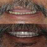 Full Mouth Rehabilitation Before & After case