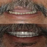 Caso de rehabilitación bucal completa antes y después