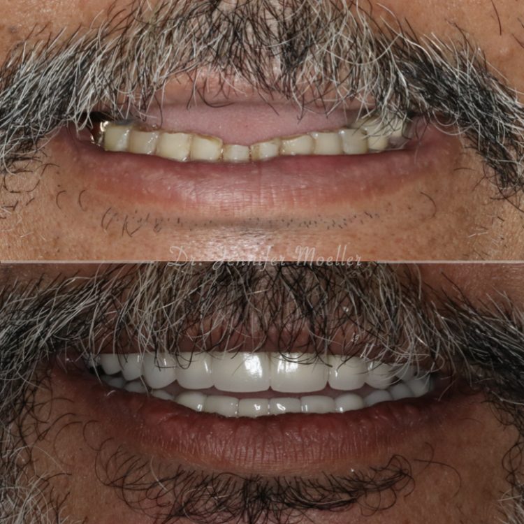 Full Mouth Rehabilitation Before & After case