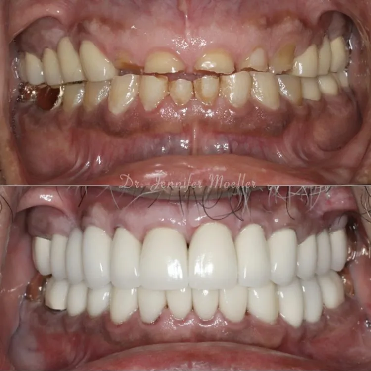 Full Mouth Rehabilitation Before & After case