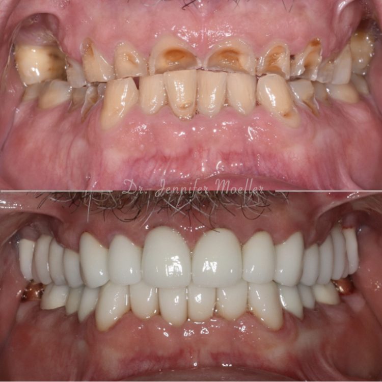 Full Mouth Rehabilitation Before & After case