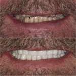 Full Mouth Rehabilitation Before & After case