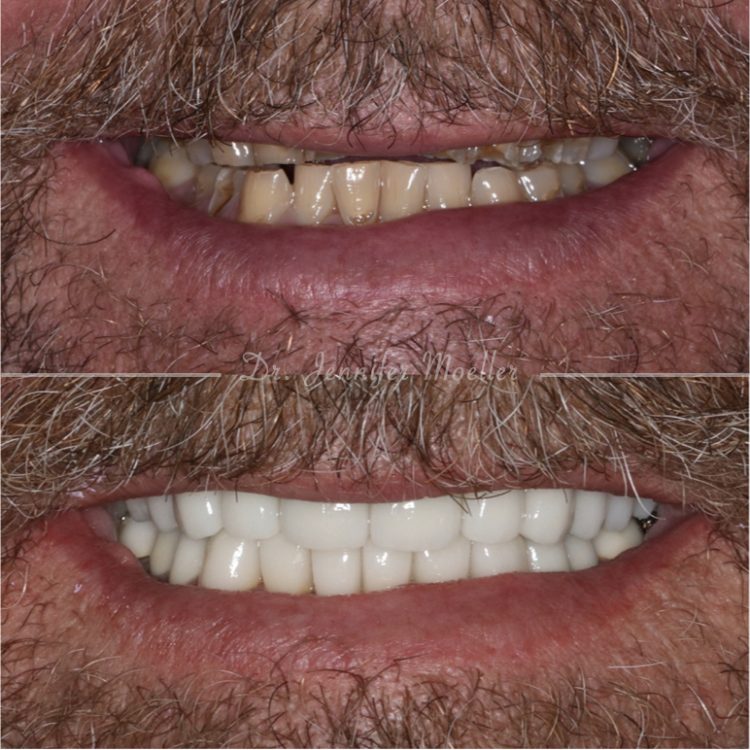 Full Mouth Rehabilitation Before & After case