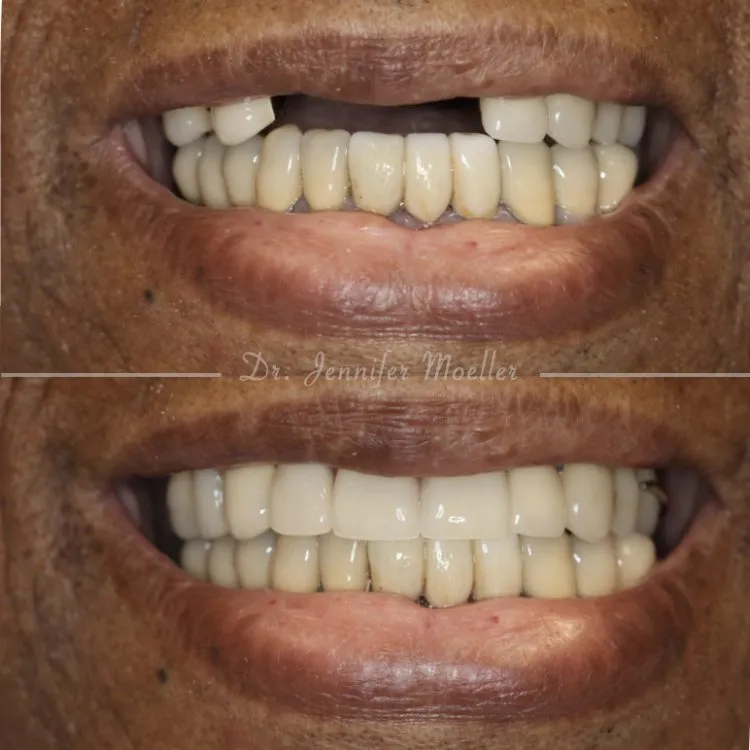 Implant Partial Dentures Before & After