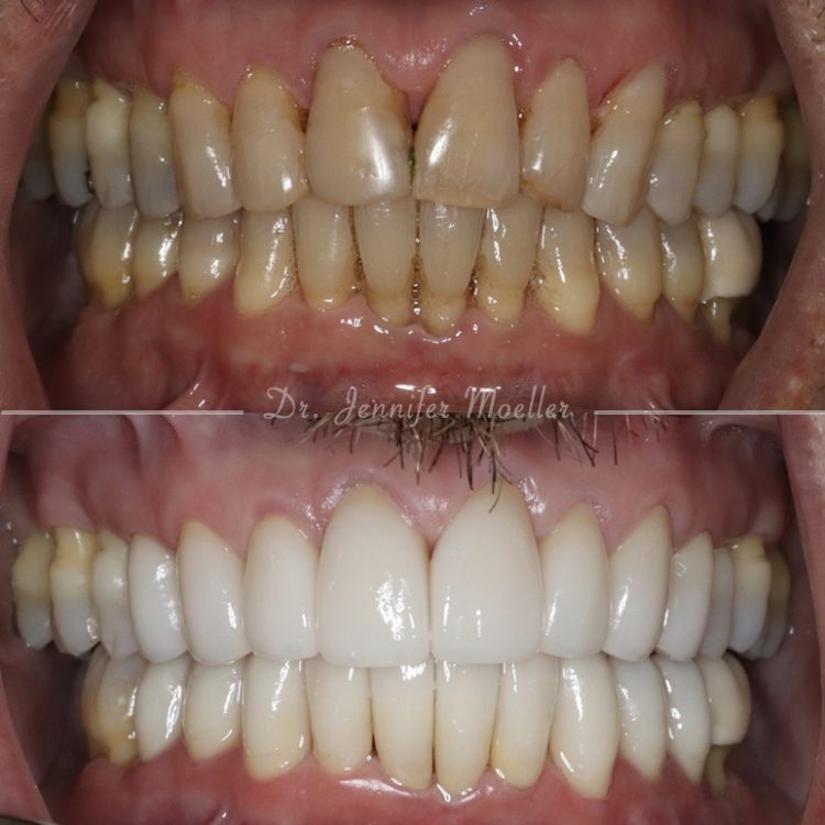 Veneers before and after