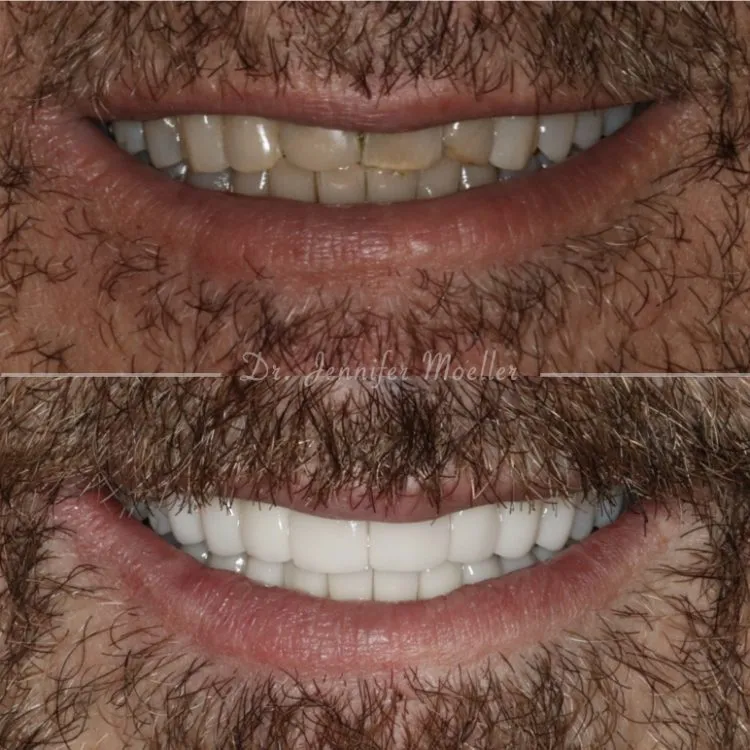 Veneers before and after