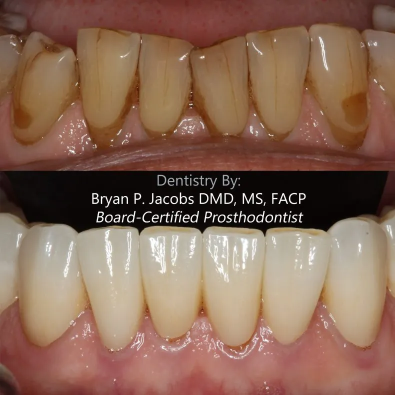 Before and after comparison of a patient's profile showing results six months after lip repositioning surgery