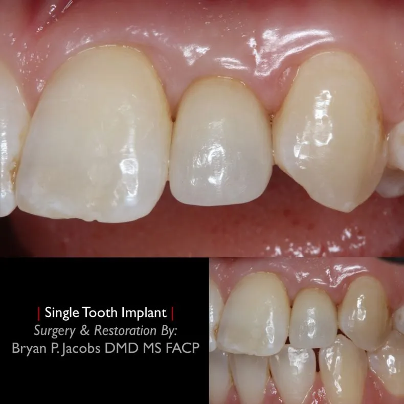 Before and after comparison of a patient's profile showing results six months after lip repositioning surgery